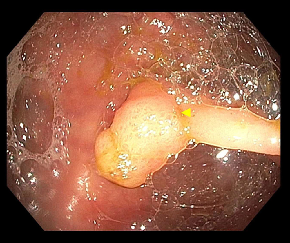 Small sessile polyp (yellow arrow) at the best of the cecum visualized on colonoscopy.