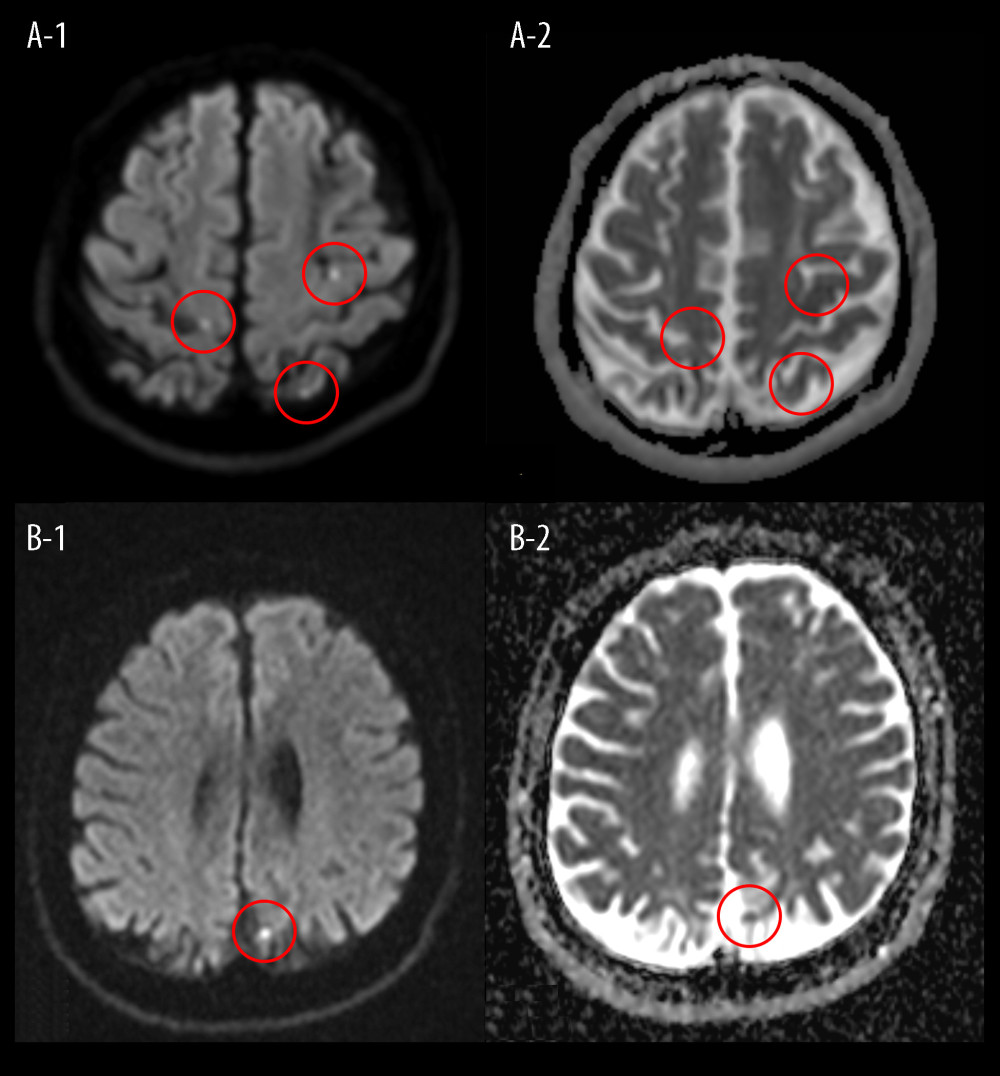 (A–1) Head MRI of our patient’s first cerebral infarction showed hyperintensity (circle) in diffusion-weighted images (A–2) and low intensity (circle) on an apparent diffusion coefficient map, along bilateral anterior and posterior circulation lesions. (B–1) Head MRI of the recurrence of our patient’s cerebral infarction showed faint hyperintensity (circle) in diffusion-weighted images (B–2) and low intensity (circle) on an apparent diffusion coefficient map, along a left parietal lesion (TR/TE): (4000/95). MRI – magnetic resonance imaging; TR/TE – repetition time/echo time (for the control of image contrast in weighted MRI).