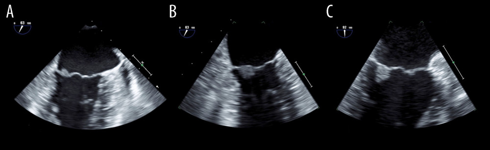 (A) Transesophageal echocardiography image of the patient’s first cerebral infarction, showing a 5×6 mm image of the mitral vegetation on the posterior leaflet; (B) Enlarged (to 7×8 mm) image of the recurrent cerebral infarction site; (C) No change was observed 72 days after the last cerebral infarction.