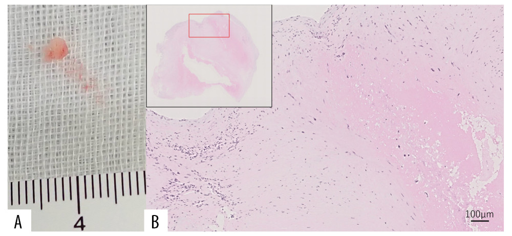 (A) Macroscopy of the mitral vegetation in the tissue sample of the patient. (B) Hematoxylin & eosin stain of the histopathological mitral vegetation tissue showing an organized fibrin thrombus with no neutrophilic infiltration (×20 magnification), consistent with Libman-Sacks endocarditis.