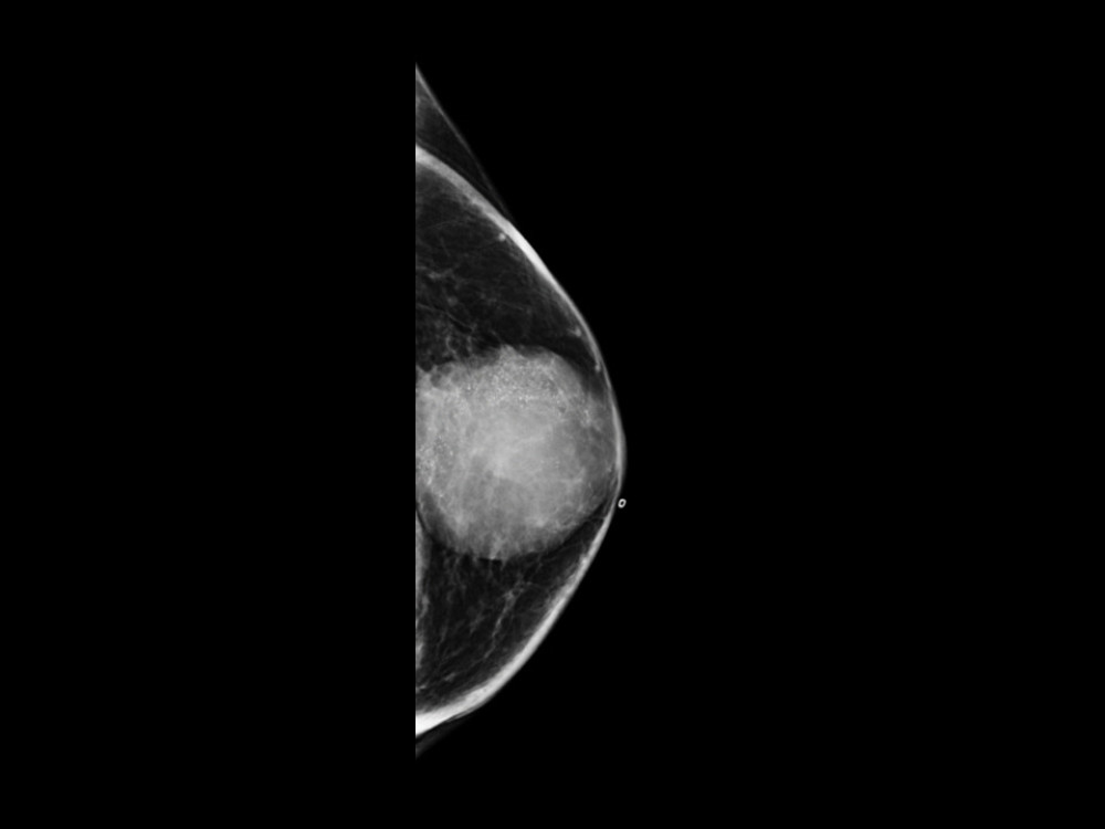 Invasive cribriform carcinoma on mammography. Craniocaudal view of the mammography shows a circumscribed, round, and hyperdense mass with internal fine pleomorphic microcalcifications in the left breast.