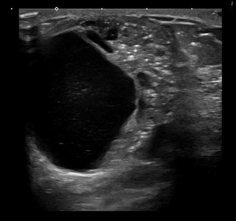 Invasive cribriform carcinoma on breast ultrasound. Breast ultrasound shows a large complex cystic and solid mass with multiple calcifications within the solid portion.