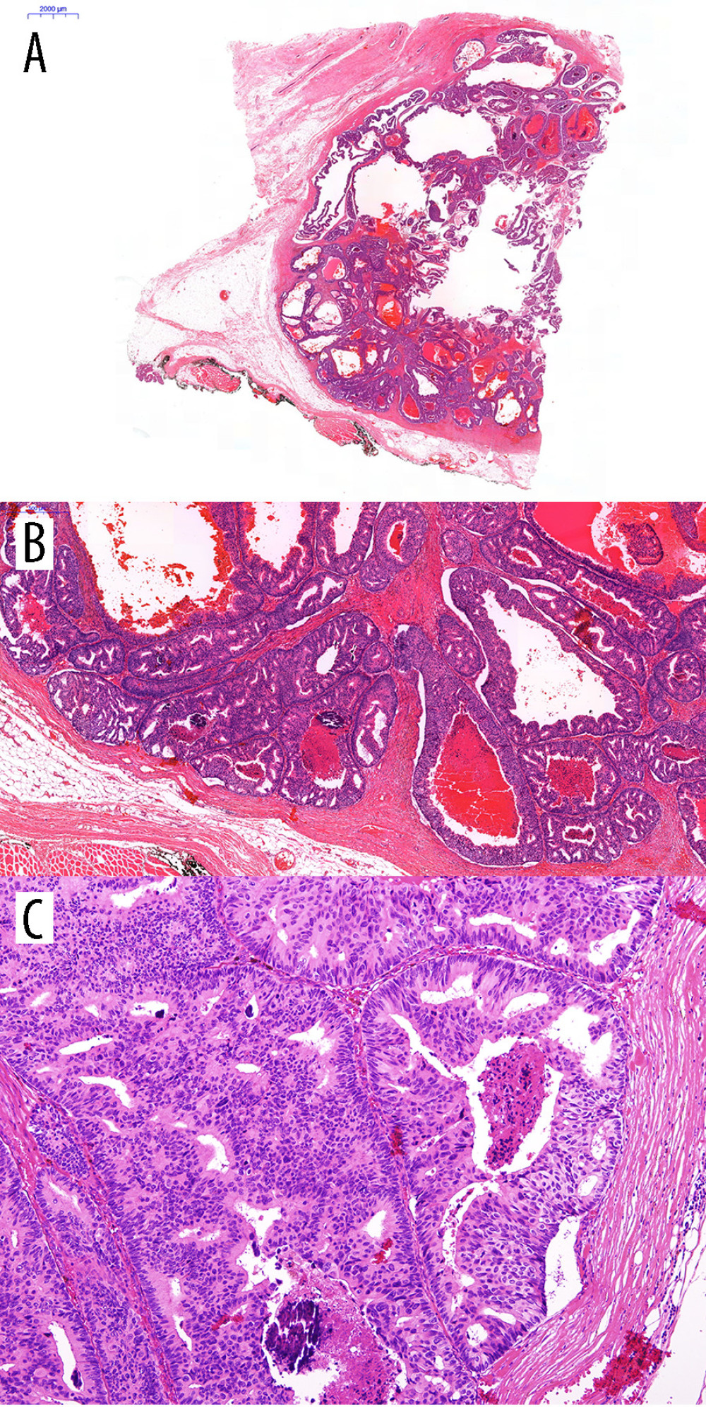 Microscopic appearance of the breast tumor. (A) Scan view of the breast lesion reveals a mass with pushing borders and hemorrhage. (B) The tumor is composed of more than 90% cribriform glands with comedo necrosis and dystrophic calcification, diagnostic for cribriform carcinoma of the breast (H&E stain, 4× objective). (C) On higher power, the carcinoma is composed of atypical cells with moderate pleomorphism, consistent with nuclear grade 2 (H&E stain, 10× objective). H&E – hematoxylin and eosin.