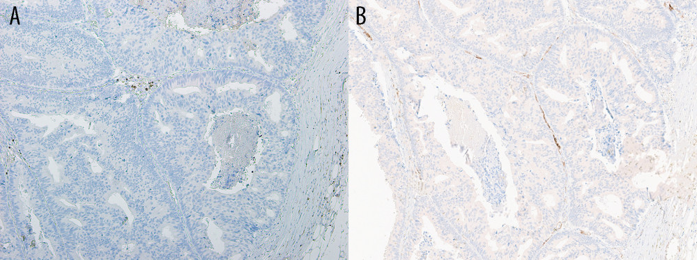 P63 and SMMHC staining of ICC. (A) P63 staining and (B) SMMHC staining confirm the lack of myoepithelial cells, consistent with invasive carcinoma (10× objective). SMMHC – smooth muscle-myosin heavy chain; ICC – invasive cribriform carcinoma.