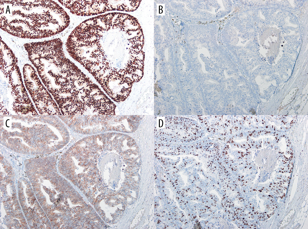 IHC staining of ICC. IHC results of the breast carcinoma reveal a luminal phenotype (all, 10× objective). (A) The carcinoma had diffusely strong ER positivity with (B) nearly negative PR positivity (<1 weakly PR+ cell/100 cells). (C) More than 10% of tumor cells showed moderately staining membranous c-erbB2 positivity (c-erbB2+ equivocal), and (D) a Ki-67 labeling index of about 30%. IHC – immunohistochemistry; ICC – invasive cribriform carcinoma; ER – estrogen receptor; PR – progesterone receptor.
