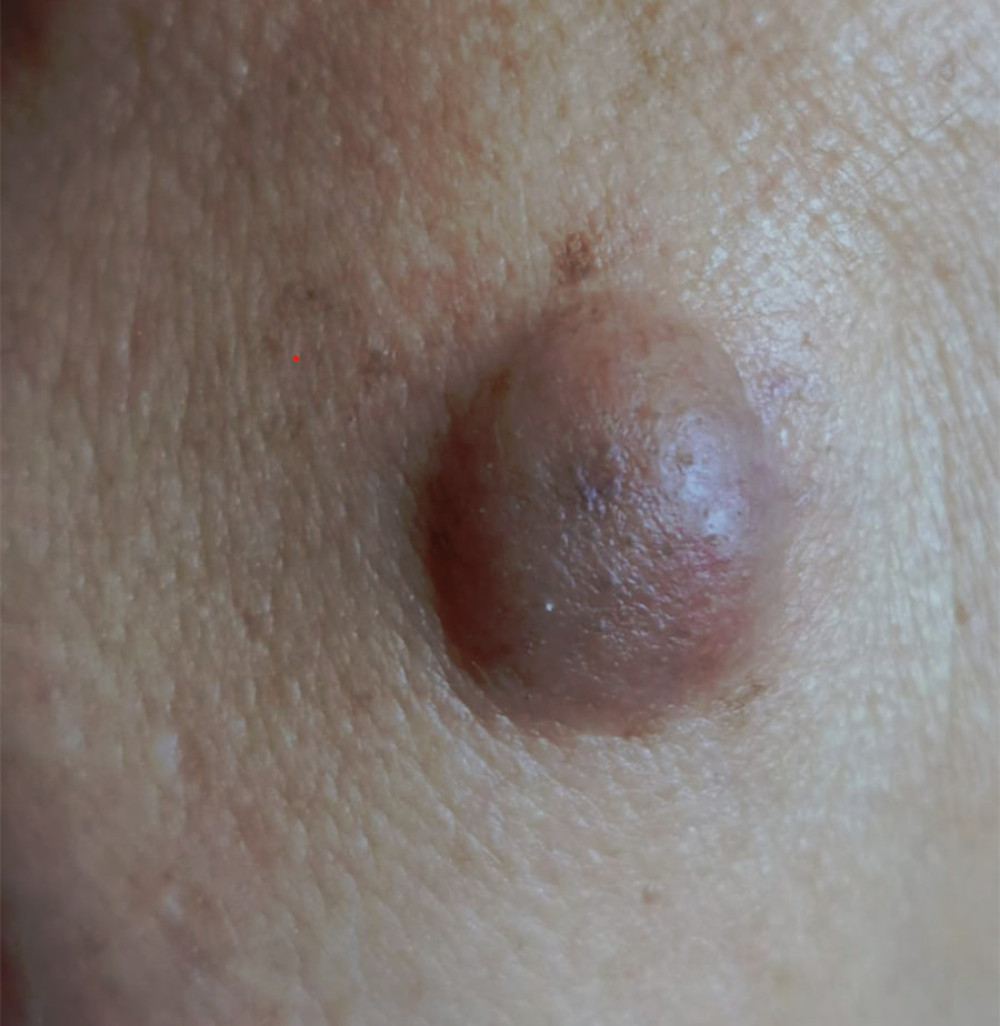 Violet erythematous nodule in malar area.