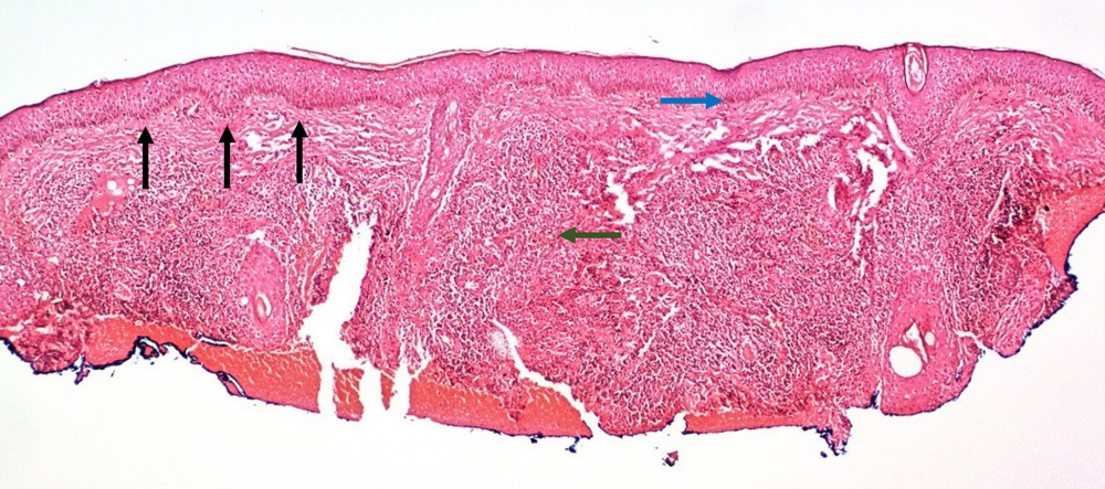 Histopathology of the patient with hematoxylin and eosin staining (10×). Green arrow: inflammatory infiltrates at the upper dermis. Black arrows: flattening of the epidermal rete ridges. Blue arrow: basal layer hyperpigmentation.