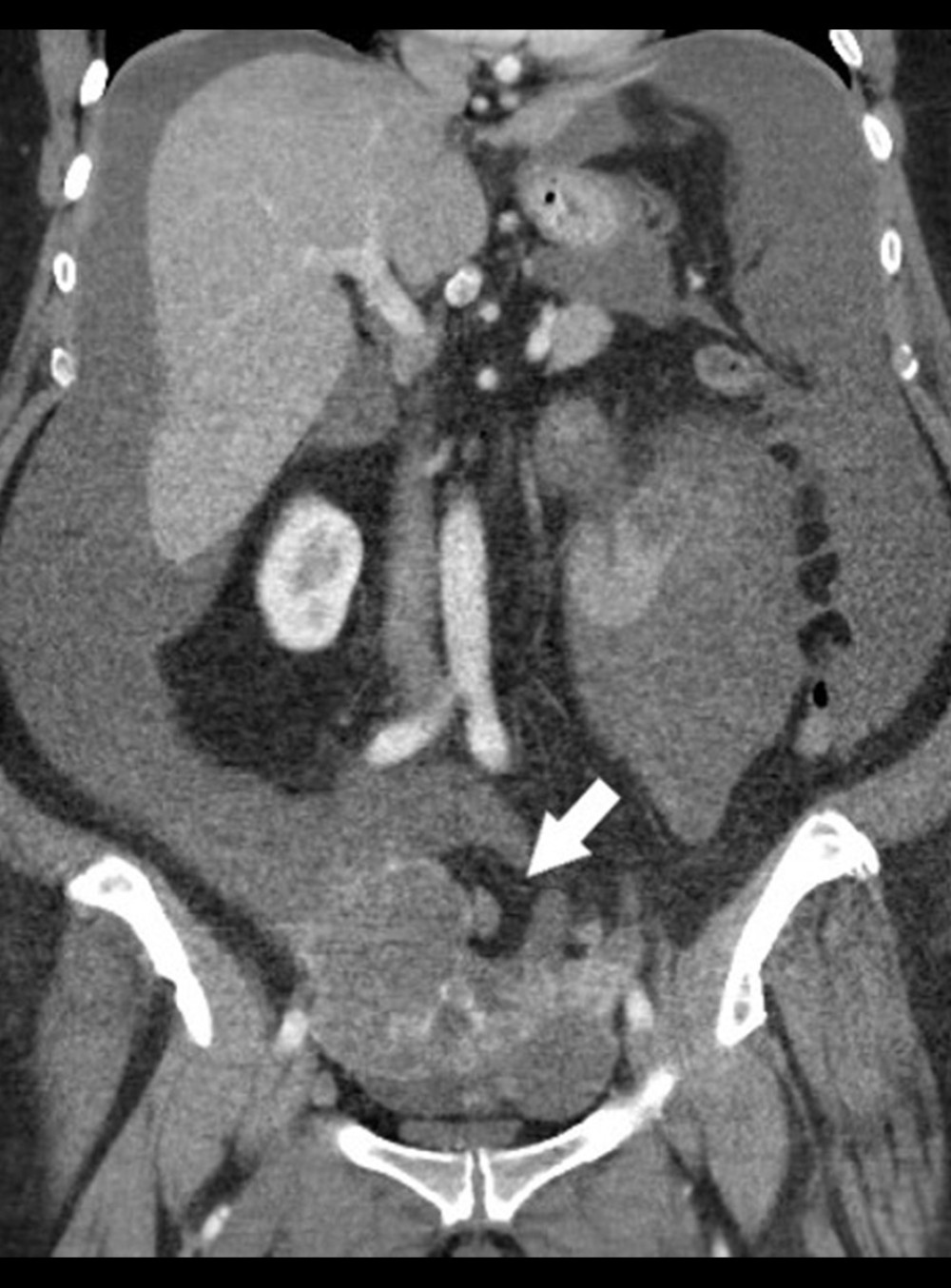 Coronal contrast-enhanced CT shows large ascites throughout the abdomen, displacing the organs centrally as well as the large cystic/solid ovarian mass (white arrow) in the pelvis. CT – computed tomography.