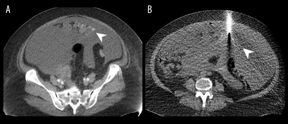 Omental caking (white arrow head) along the greater omentum is seen anteriorly with surrounding ascites on contrast-enhanced CT at presentation (A), which was subsequently biopsied with an 18-gauge needle under CT guidance (B). CT – computed tomography.