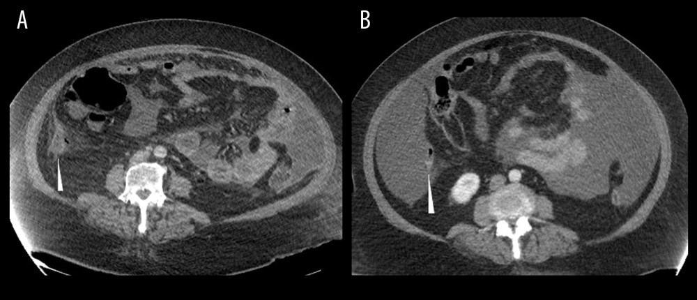 (A) The patient’s appendix is seen in the right lower quadrant (white triangle), enlarged and inflamed, with a small fleck of adjacent extraluminal air. (B) As a reference, her appendix was small, non-inflamed, and normal on her original presenting CT. CT – computed tomography.