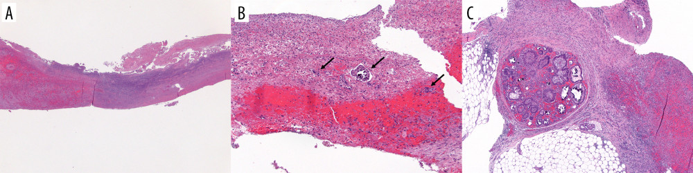 Histology. Hematoxylin and Eosin (H&E) stains of (A) thin appendix wall with acute gangrenous appendicitis (20× magnification) and (B) representative clusters of malignant cells (arrows) in appendix wall near perforation site (100× magnification). H&E stain of (C) omentum shows low-grade papillary serous carcinoma with associated prominent acute inflammation and patchy gangrenous necrosis.