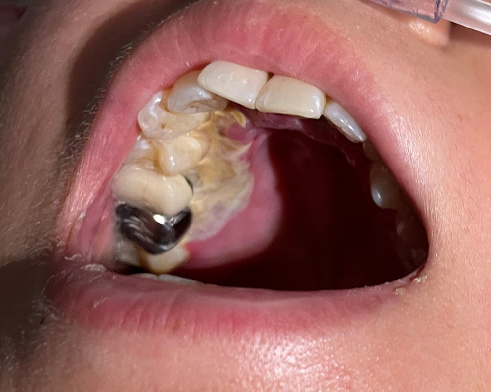 Discoid lupus erythematosus presenting with oral ulcer located on the gum.