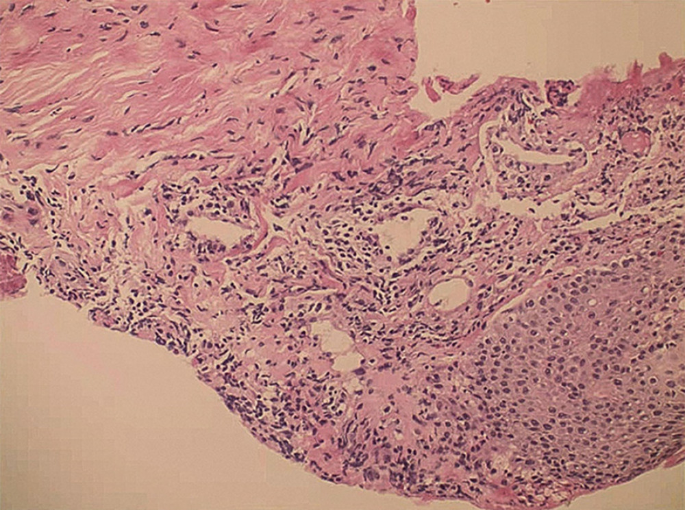 Gingival mucosa biopsy demonstrating chronic inflammation of squamous epithelium interstitial lymphocyte diffuse infiltration (hematoxylin and eosin stain).