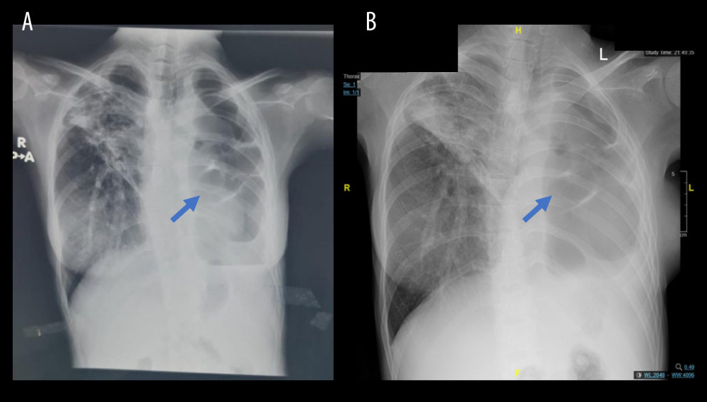 (A, B) Chest X-ray at 8 months of pregnancy and latest X-ray. (Arrow: giant lung bullae).