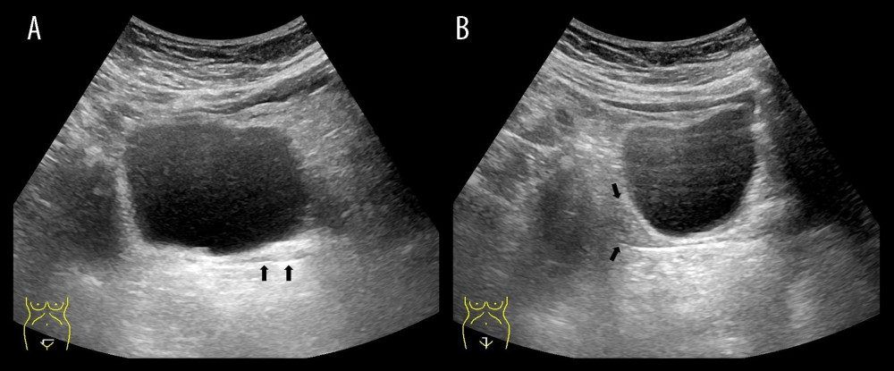 (A) Axial transabdominal ultrasonography image shows no median uterine structure, and (B) sagittal image shows no normal vaginal structure but a small echoic structure at the posterior border or the bladder (arrows).