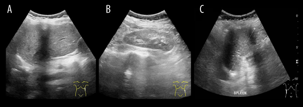 Sagittal transabdominal ultrasonography images show the location of (A) the liver in the left body side, (B) a kidney identified only in the left flank area, and (C) the spleen in the right body side.