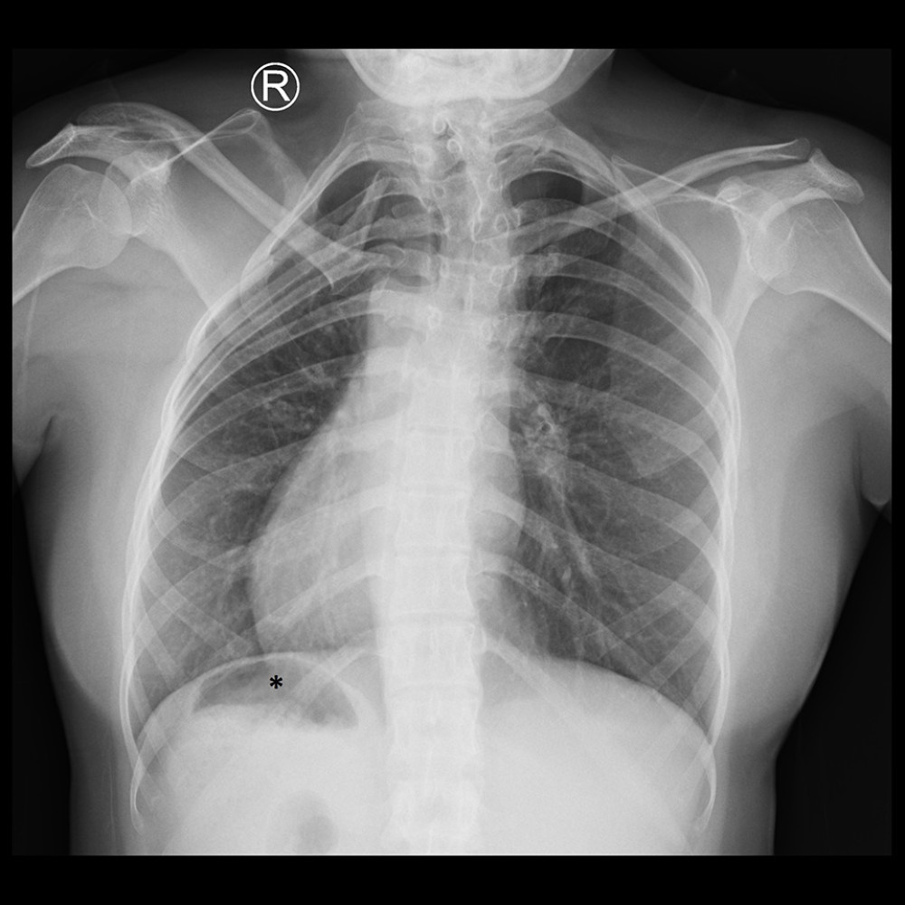 Patient’s chest X-ray shows dextrocardia and thoracal scoliosis. The stomach (*) bubble is visible in the right upper quadrant.