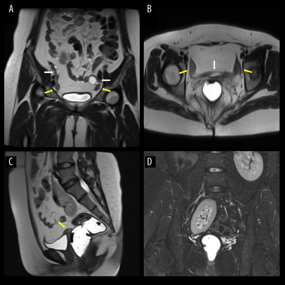 MRI images of the patient’s pelvis. (A) Coronal T2 image shows bilateral isointense rudimentary uterine remnants (yellow arrow), lying in caudal relationship to both normal ovaries (white arrow). (B) Axial T2 image shows a thick hyperintense band (white arrow) connecting the bilateral uterine remnants (yellow arrow). (C) Sagittal T2 image shows absence of a normal morphology uterus and cervix between bladder and rectum; but a triangular midline structure above the bladder dome (yellow arrow). (D) Coronal fat-suppressed T2 image shows presence of a right pelvic kidney.