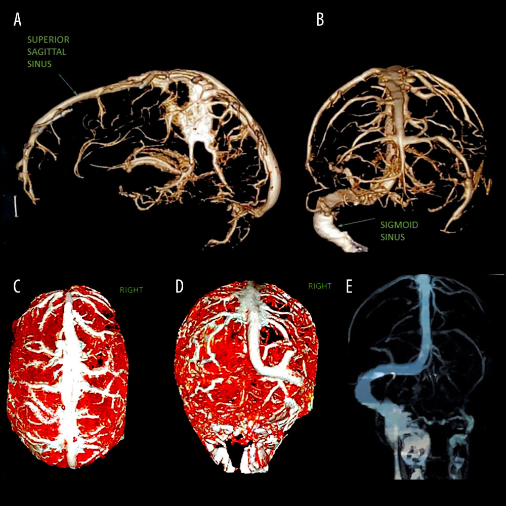 (A–E) Cerebral magnetic resonance angiography after injection of venous contrast showing filling defects in the left transverse and sigmoid sinuses.