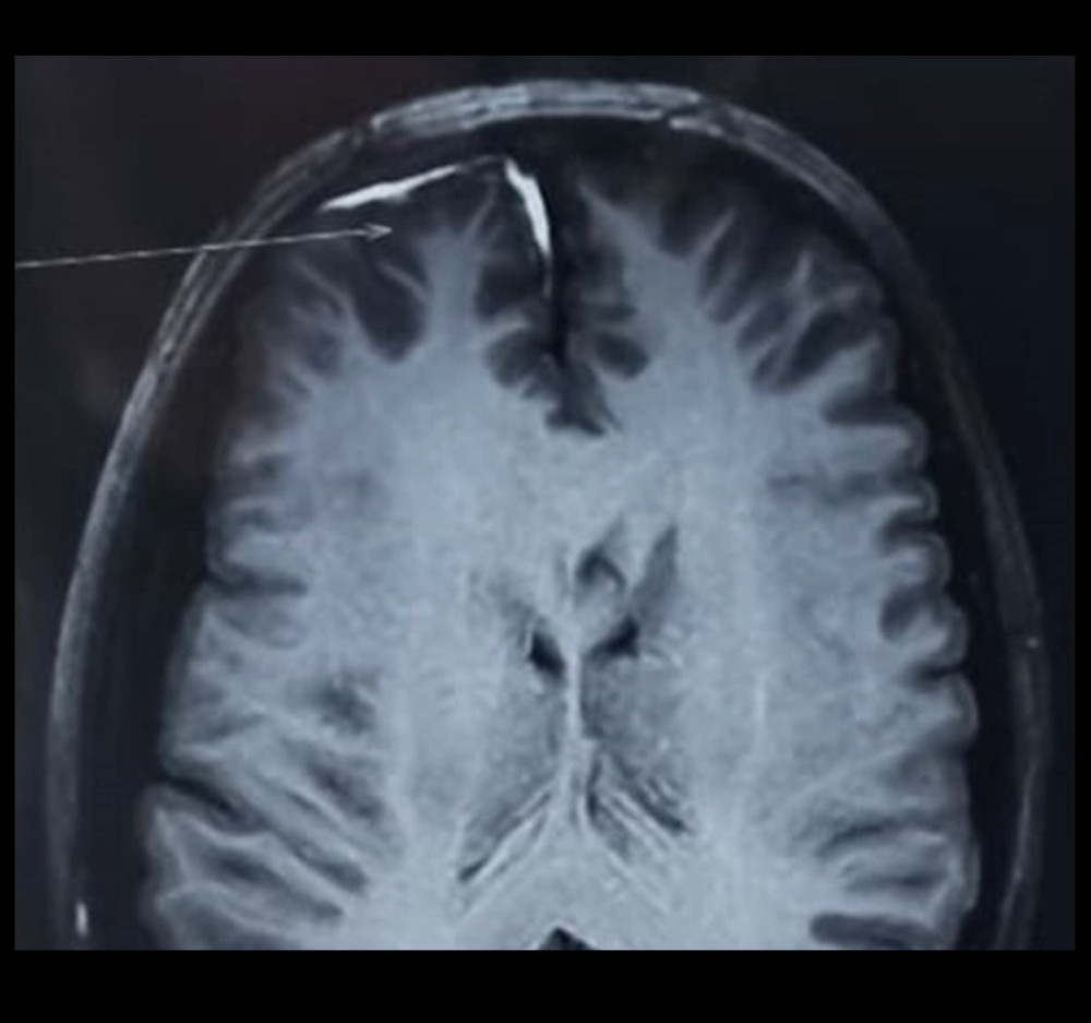 T1-weighted magnetic resonance showing pachymeningeal thickening in the right cerebral hemisphere, with contrast enhancement (arrow).