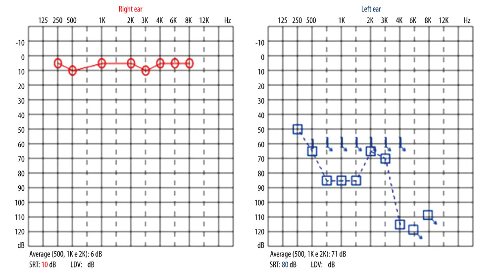 Pure tone audiometry with hearing thresholds within normal ranges in the right ear and severe sensorineural hearing loss, with a ramp configuration in the left ear. The speech recognition thresholds were 10 dB on the right and 80 dB on the left.