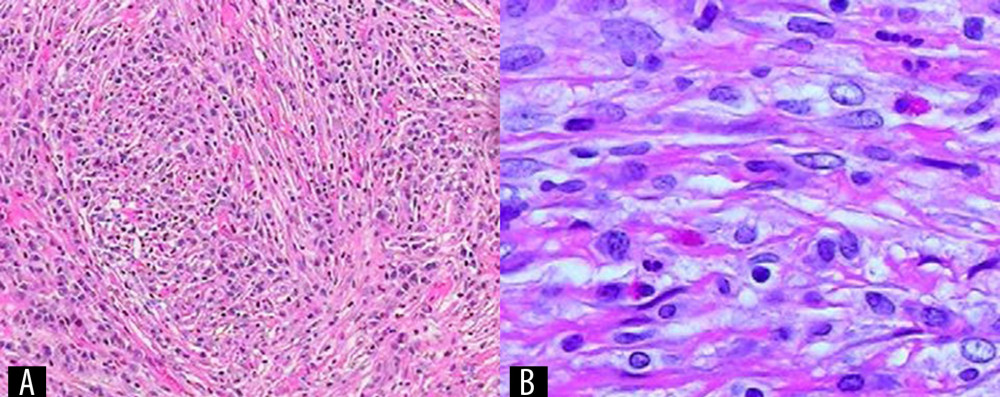 (A, B) Fragments revealing proliferation of elongated cells without atypia, with the appearance of reactive myofibroblasts, forming fascicles and with areas in a storiform pattern. Intense lymphoplasmacytic infiltrate without atypia was seen, sometimes forming aggregates. Collections of xanthomatous histiocytes can also be seen.