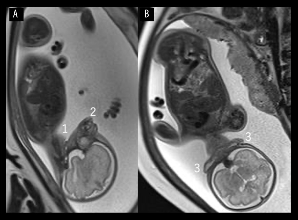 Fetal magnetic resonance imaging at 31 weeks of gestation. (A) Sagittal plane and (B) coronal plane showed fetal facial abnormalities. (1) Pathway only inferior from the larynx to the trachea. (2) Hypoplastic mandible. (3) Extreme lower position of bilateral auricles.