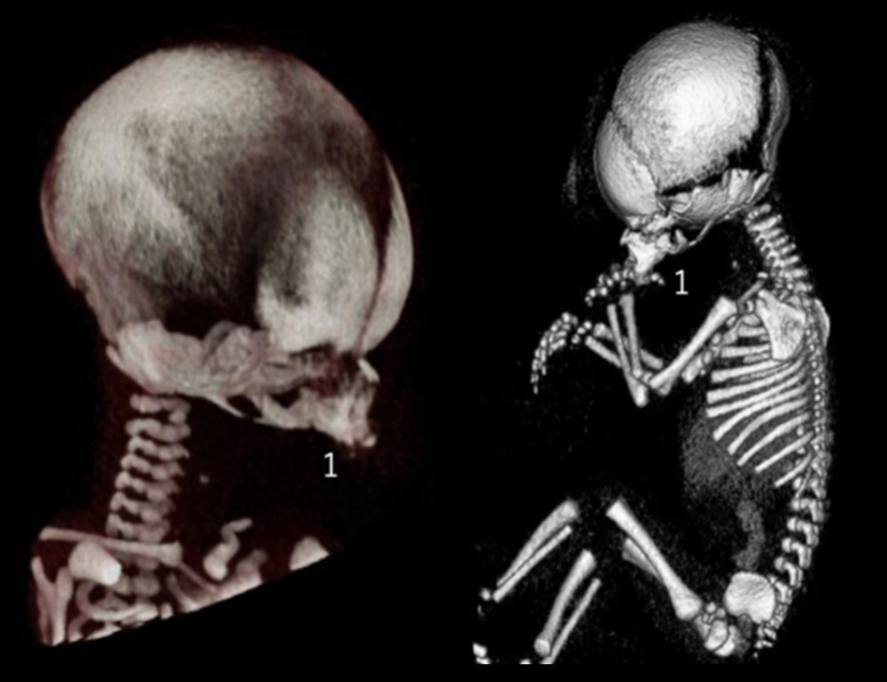 Fetal 3-dimensional computed tomography scan at 32 weeks of gestation. (1) Extremely hypoplastic mandible.