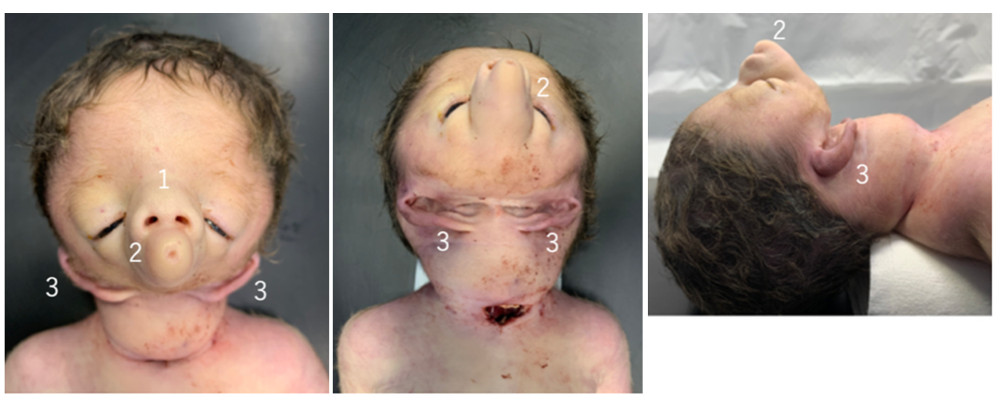 Neonate died 12 h after the EXIT procedure due to respiratory failure. (1) Malformed nose. (2) Malformed mouth. (3) Bilateral auricles.