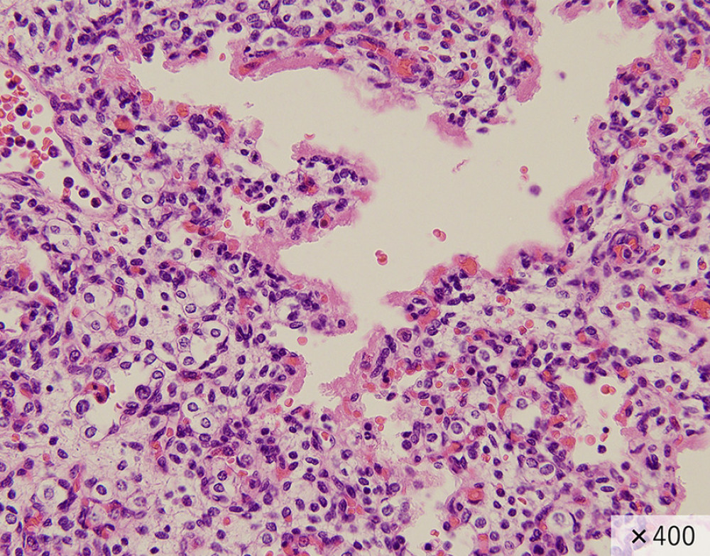 Hematoxylin and eosin stain. The lung development was in the canalicular stage. The alveolar ducts, which are empty spaces, indicate the air trapped in the lungs. No alveoli.
