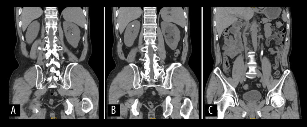 Preoperative computed tomography, revealing (A) a left renal calculus, (B) a right renal calculus, and (C) a left ureteral stone.