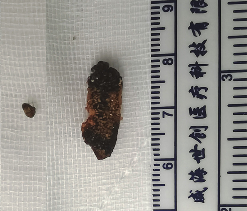 Specimen of the large ureteral calculus and smaller renal calculus.