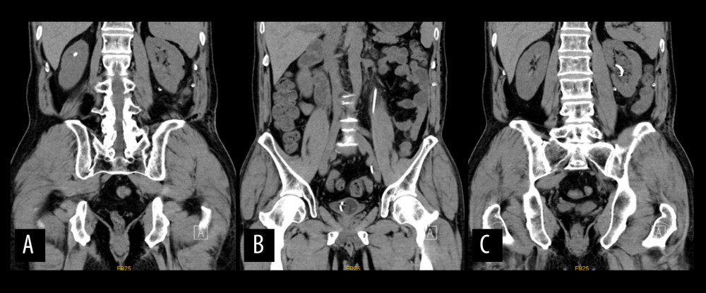 Postoperative computed tomography, revealing (A) a right renal calculus and (B, C) left double-J stent before removal.