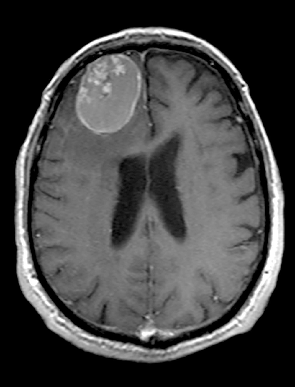 Brain MRI in the transverse plane, T1-weighted post-gadolinium, showing a hypotense appearance of the cystic compartment and a ring-enhancing lesion, while the solid compartment of the tumor appears hypertense. There is also significant peritumoral edema present.