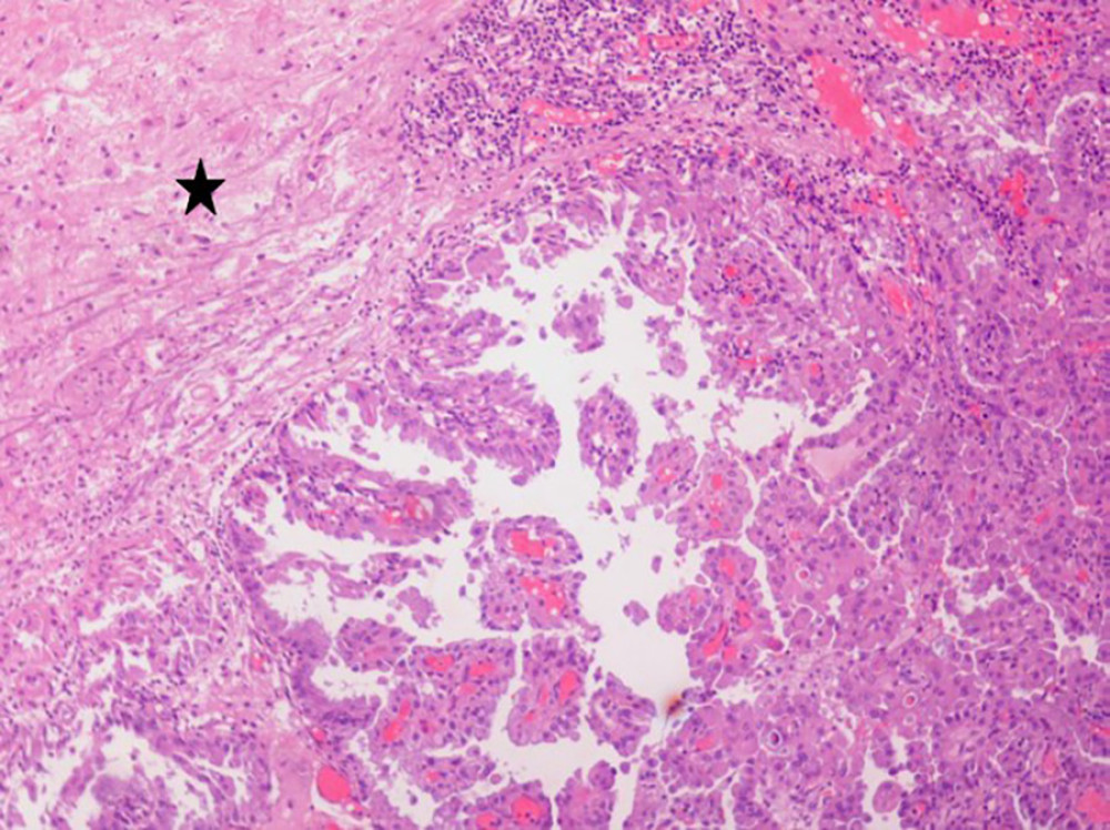Metastasis of thyroid papillary carcinoma in the brain. Asterisk on the left shows brain parenchyma. The neoplasm exhibits papillary pattern and typical morphological nuclear features of thyroid papillary carcinoma. Hematoxylin and eosin (H&E). Magnification, objective ×100.