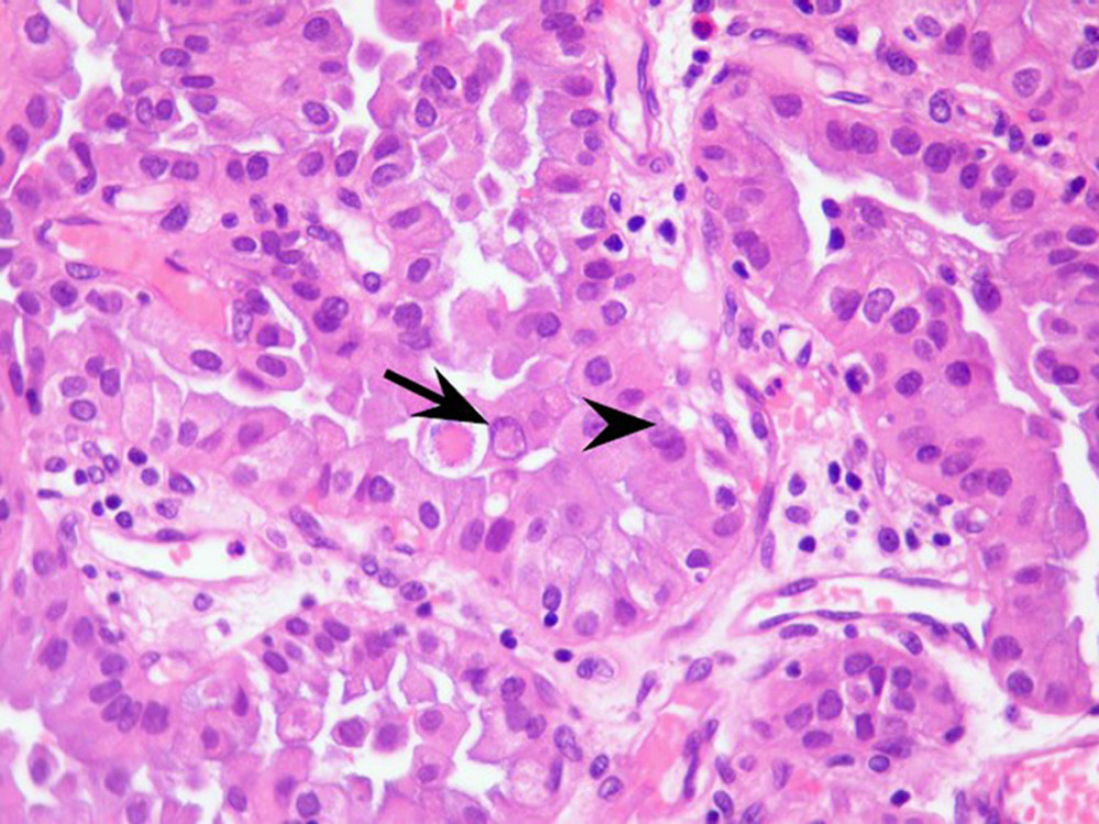 Metastasis of thyroid papillary carcinoma in the brain. Nuclear pseudo-inclusions and grooves indicated by the arrow and the arrowhead. The neoplasm exhibits a papillary pattern and typical morphological nuclear features of thyroid papillary carcinoma. Hematoxylin and eosin (H&E). Magnification, objective ×400.