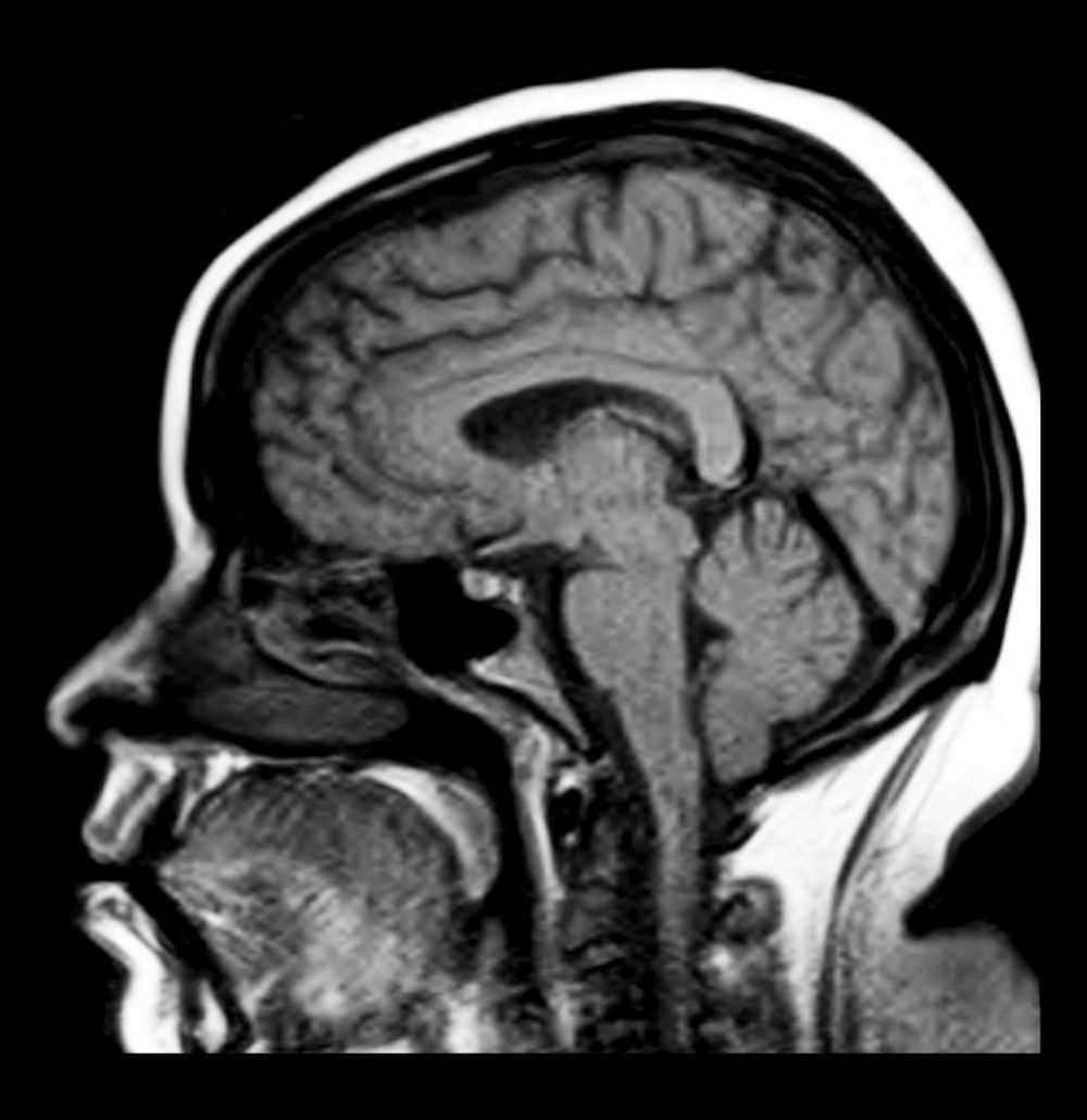 MRI of T1-weighted sagittal view of the brain showing normal pituitary gland.