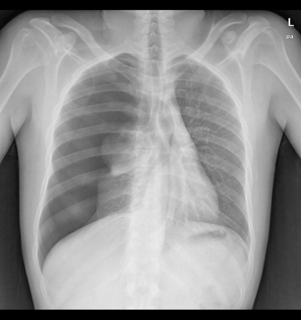 Posterior-anterior chest X-ray shows tension pneumothorax with mediastinal shifting.