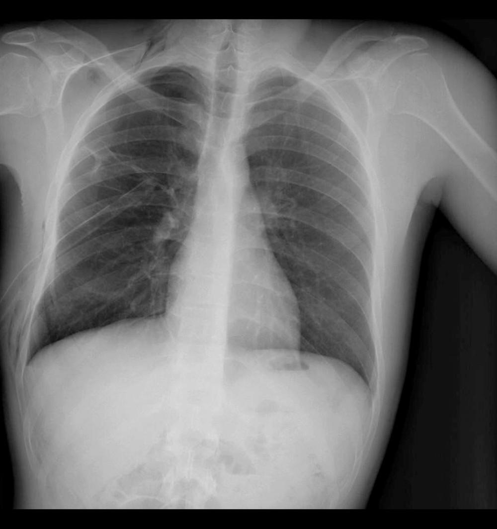 Chest X-ray after chest tube insertion. There is complete resolution of the pneumothorax and the right lung is fully expanded.