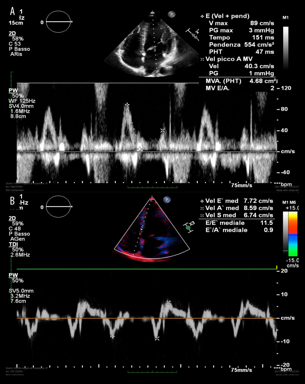 Transthoracic echocardiogram. (A) Pulsed Wave showing normal E/A wave ratio. (B) Tissue Doppler (TDI) showing inversion of E’/A’ ratio, with a 11.5 E/e’ ratio.