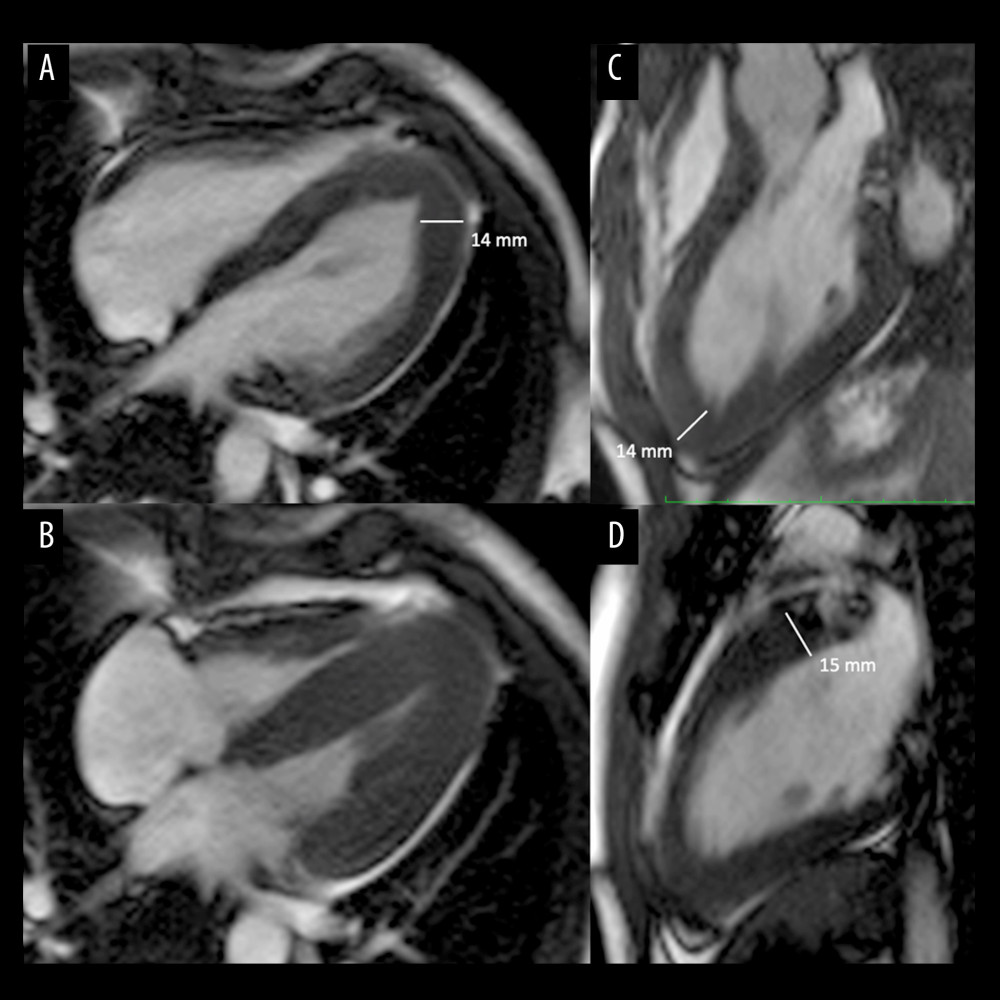 Cardiac magnetic resonance imaging: (A) 4-chamber view. (B) 4-chamber view: complete obliteration of left ventricle apex in systole. (C) LVOT view. (D) 2-chamber view.