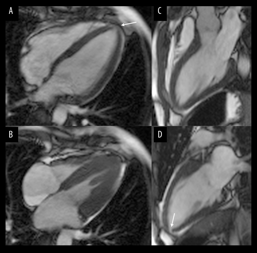 (A–D) Cardiac magnetic resonance imaging showing significant reduction of LVH. Arrow: microaneurysm of left ventricular apex.