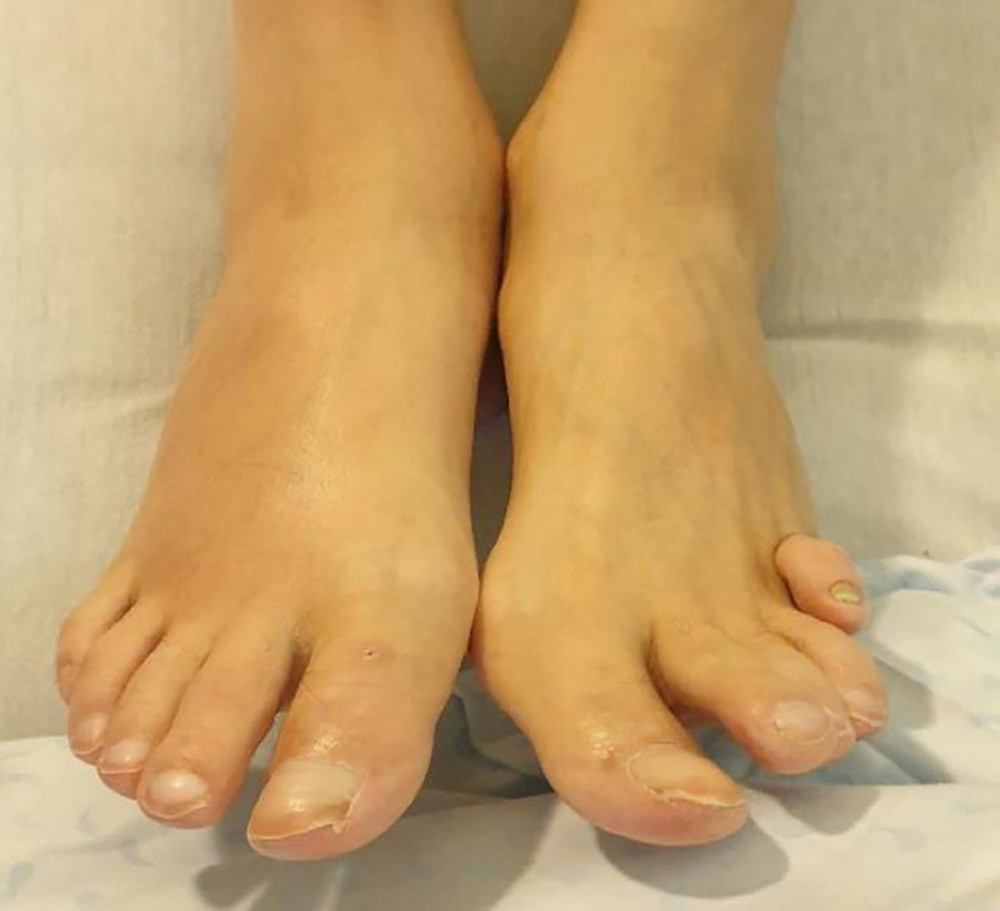 Clinical presentation. Picture of the patient’s feet put next to each other to show the swollen red right foot compared to the healthy left foot.