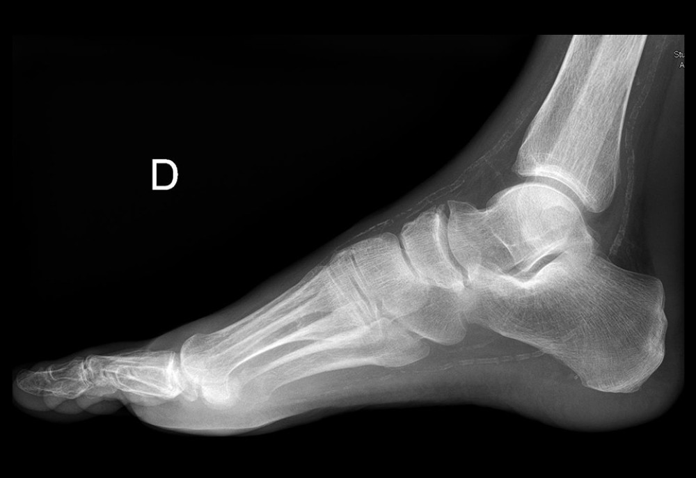 Right foot radiography. Sagittal incidence, where we can see vascular calcifications along with talonavicular osteoarthritis with no suggestion of Charcot foot.