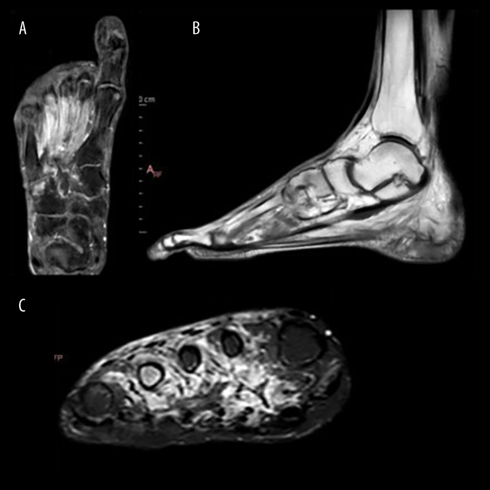 (A-C) MRI of the right foot with different incidences showing multiple fractures (see text) with associated mechanical overload bone edema typical of a bone stress fracture.