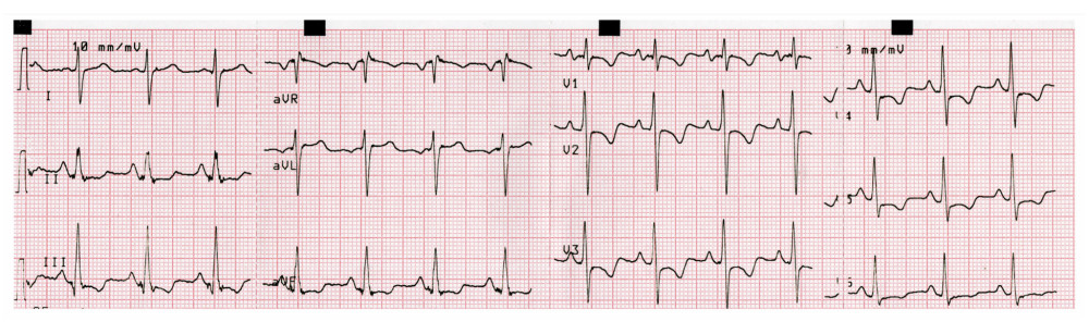 Twelve-lead electrocardiogram showing sinus rhythm (94 beats/min); a pattern of prominent S wave in I, Q wave in III, and negative T wave in III; inverted T waves in inferior and precordial leads; diffuse ST-segment depression; right atrial enlargement; and incomplete right bundle branch block.