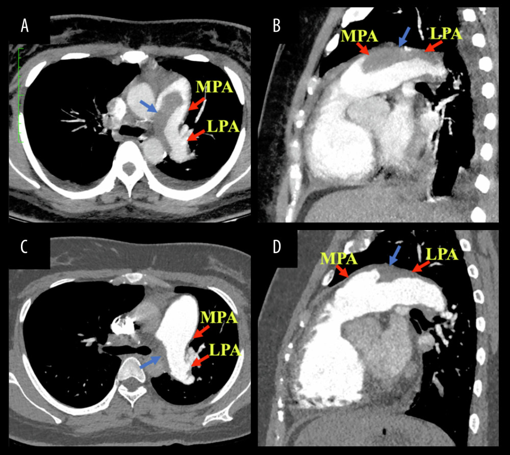 Computed tomography pulmonary angiography with axial (A) and sagittal (B) views showing large and occlusive filling defects (blue arrows) predominantly involving the MPA and LPA on admission. After thrombolysis, a significant reduction of the filling defects (blue arrows) in the MPA and LPA are shown in the axial (C) and sagittal (D) views. MPA – main pulmonary artery; LPA – left pulmonary artery.