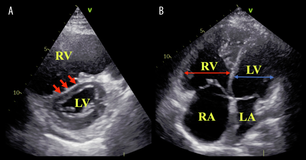 Transthoracic echocardiogram with parasternal short axis view at end-systole demonstrating a D-shaped LV (red arrows) (A). Apical 4-chamber view at end-diastole showing a RV (red line) to LV (blue line) diameter ratio greater than 1, in addition to RA and RV enlargement (B). LA – left atrium; LV – left ventricle; RA – right atrium; RV – right ventricle.