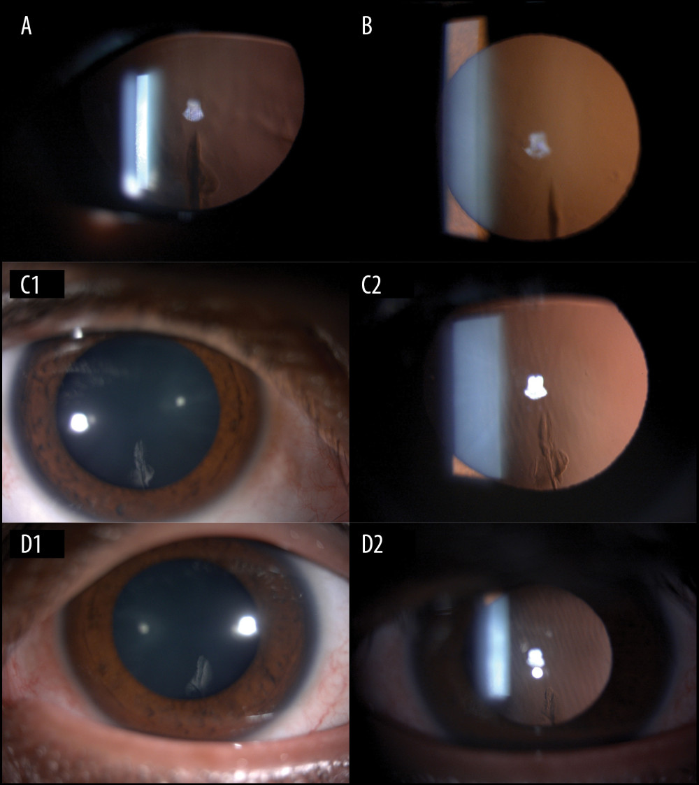 Slit-lamp photos of splinter cortical cataract. (A) Slit-lamp photo with retroillumination of the left crystalline lens of patient #2 showing inferotemporal splinter cortical cataract. (B) Slit-lamp photo with retroillumination of the left crystalline lens of patient #3 showing inferotemporal splinter cortical cataract. (C–1, C–2) are slit-lamp photos with diffused and retroillumination of the right crystalline lens of patient #14 showing splinter cortical cataract. (D–1, D–2) are slit-lamp photos with diffused and retroillumination of the left crystalline lens of patient #15 showing splinter cortical cataract.