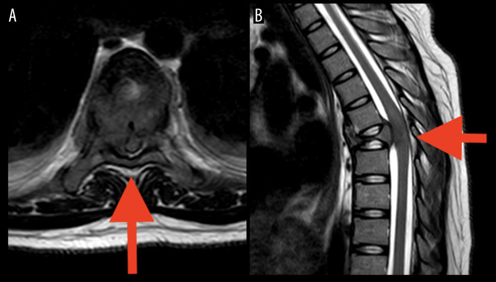 Preoperative MRI showing the location and spinal involvement of the GCTB. (A) Coronal section. (B) Axial section. * Red arrows point to the tumor location.